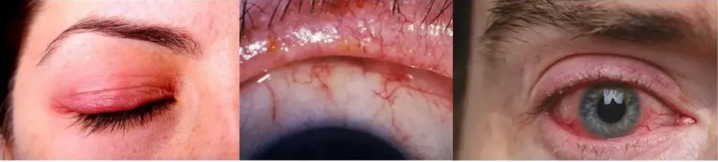 Apresentações clínicas da Rosácea ocular