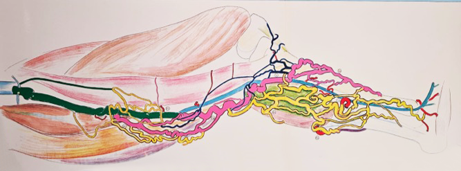 Imagem ilustrando como uma safena doente pode originar varizes
